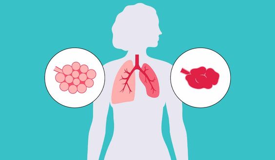 Atelectasis: Causes, Symptoms, Diagnosis and Treatment